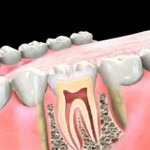 Do You Need a Root Canal Procedure?