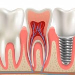 When to Choose Mini Dental Implants